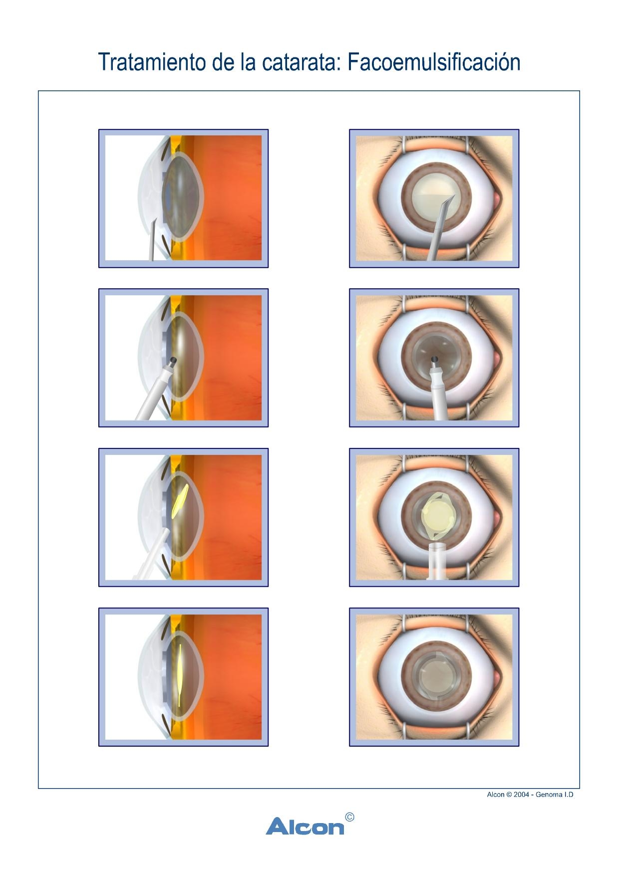 CIRUGÍA CATARATA - FACOEMULSIFICACION- LENTE INTRAOCULAR